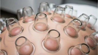 Dry cupping therapy cups placed on the back
