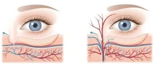 how to get rid of dark under-eye circles without makeup -1